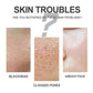 Blackheads Cream for Deep Cleansing and Excess Oil